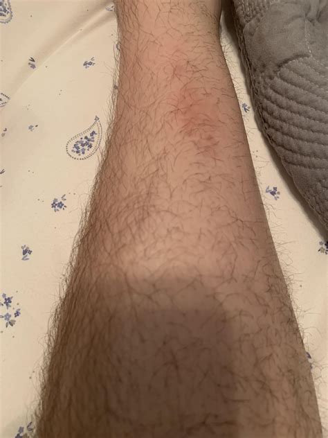 Been on and off on both legs for about 6 months now a little more