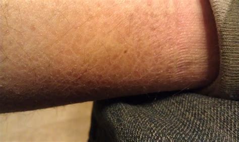 Ichthyosis vulgaris: Pictures, diagnosis, and treatment