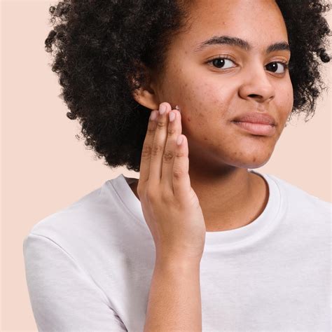 Acne scarring | Eau Thermale Avène