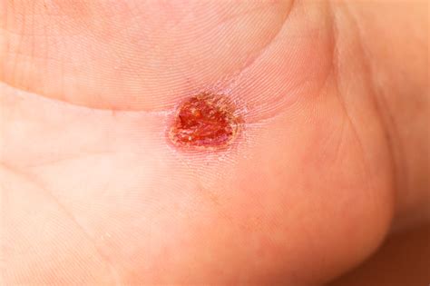 Expert Wound Care Treatment in Los Angeles | LA Vascular Specialists