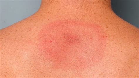 ¿Cómo detectar enfermedad de Lyme? - MipSalud