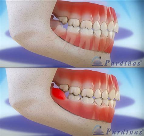 Infección de muela. Síntomas y tratamientos para eliminarla - Gaceta Dental