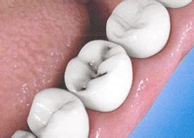 diagnosing cavities pinefield dental