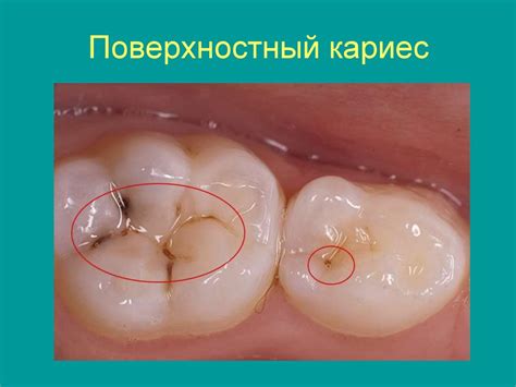 Лечение кариеса - презентация онлайн