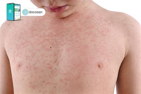 Bệnh sởi: Nguyên nhân, triệu chứng, điều trị và phòng bệnh