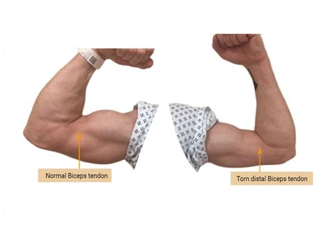 Distal Biceps Rupture Ultrasound