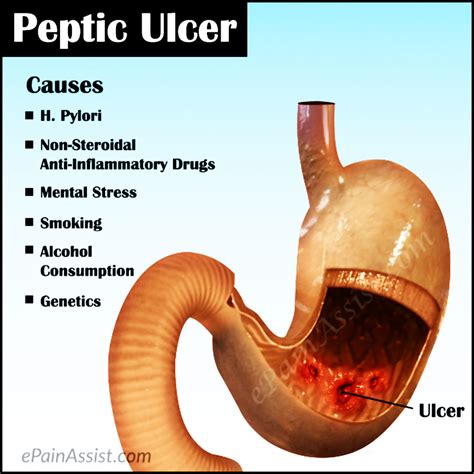 Ulcer No More