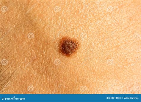 Mole on the Cheek. Dermatology, Surgery, Milanoma, Melanin. Skin ...