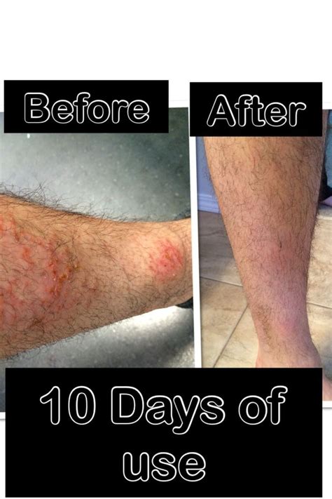 how to treat skin rash from bactrim