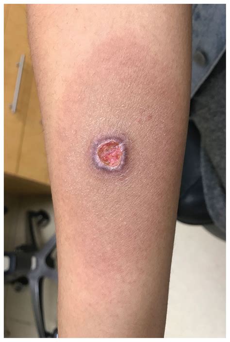 What Does A Positive Tb Skin Test Look Like Healthcareforbes ...
