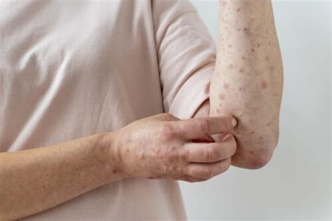 Viral Skin Infections Treatment in Ahmedabad - Dr. Sneha's Skin Solutions