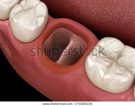 Dry Sockets After Tooth Extraction: Over 9 Royalty-Free Licensable ...