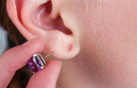 How To Treat An Infected Ear Piercing? Symptoms And Prevention