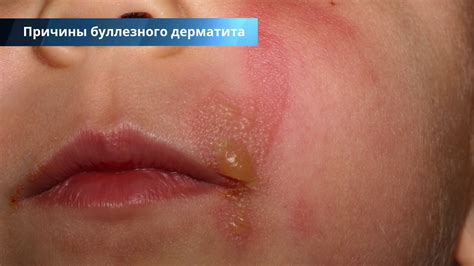 Кожный дерматит симптомы и лечение фото