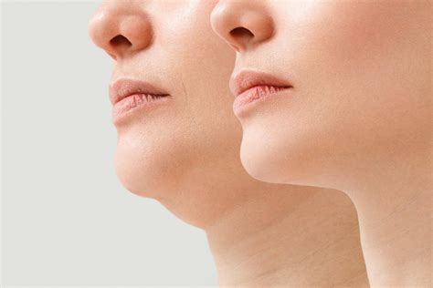 Chin double treatment - Gattonimed.com