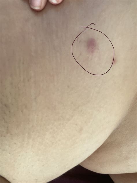 I have this lump on my right side of my breast it hurts when I try to