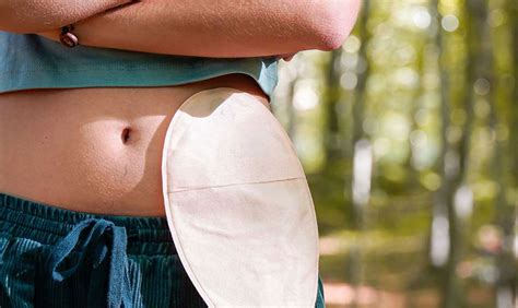 A Comprehensive Guide to Living Well with an Ostomy - LucyKingdom