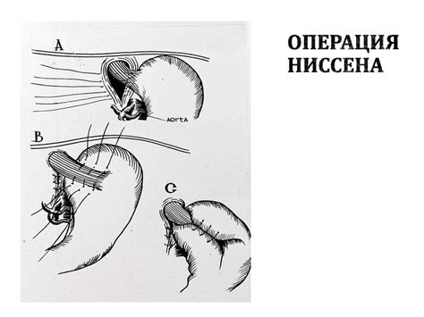 Диафрагмальные грыжи - презентация онлайн