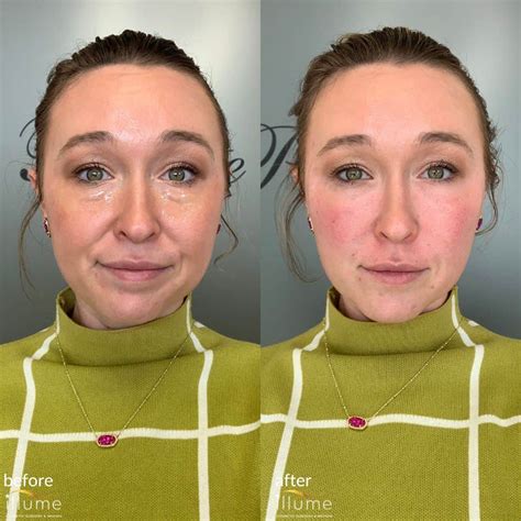 Biofiller - Illume Cosmetic Surgery & MedSpa