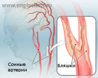 Атеросклероз (стеноз и окклюзия) сонных артерий - диагностика и лечение ...