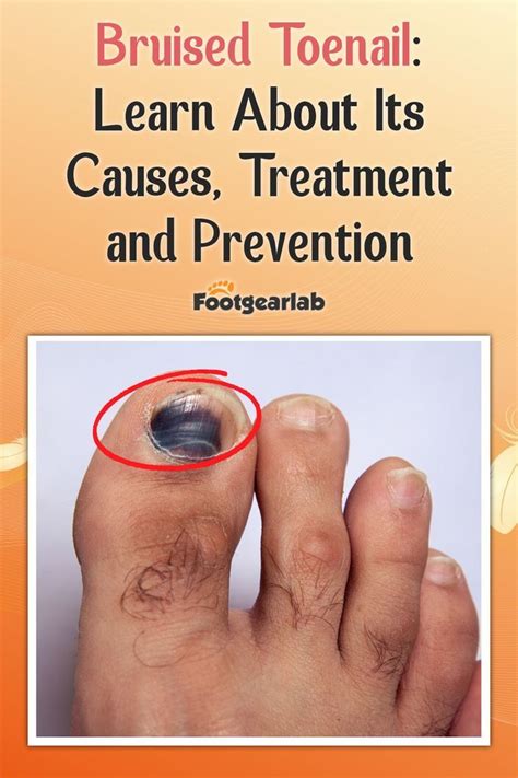 Bruised toenail learn about its causes treatment and prevention – Artofit