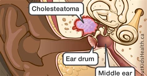 ear - MASTOIDECTOMY - Dr. Meenesh Juvekar - ENT Specialist