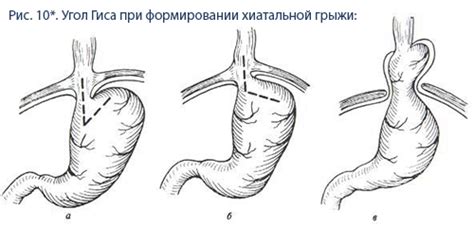 Хирургическое лечение хиатальных грыж