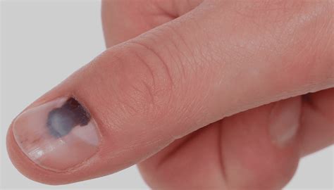 Risco Preto Na Unha Da Mão - O Que Você Precisa Saber Sobre A Mão Simiesca! - Blog Da Saúde