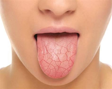 Dry Mouth Facts and Tips | Dentist Burlington | Appleby Dental