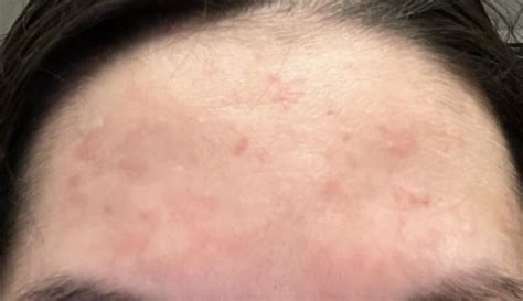 Red itchy patches on forehead? : r/SebDerm