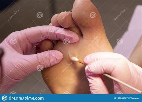 cauterizing  wound   callus stock image image  chiropody