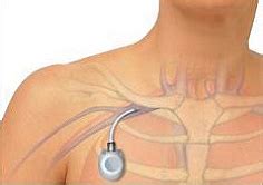 Port-a-Cath post-op instructions - University Hospitals Sussex NHS ...