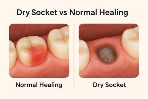 Dry Socket Vs Normal Healing Pictures