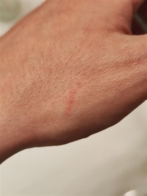 Does this look like active scabies? : r/scabies