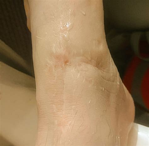 EHL Tendon Laceration (Healing Progression) : r/InjuriesAndWounds