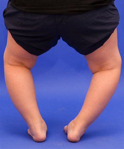 year  girl  rickets underlying bone problem cllc montreal