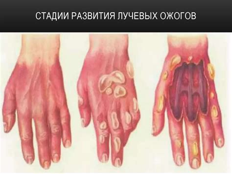 Радиационные поражения мирного времени - презентация онлайн