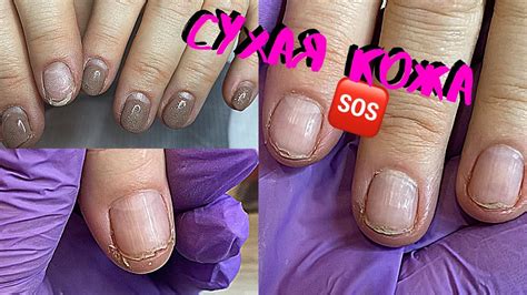 😱ЖУТКО СУХАЯ КОЖА ️ДЕЛАЕМ КОРРЕКЦИЮ| |ТРЕЩИНЫ НА ПАЛЬЦАХ РУК В КРОВЬ ...
