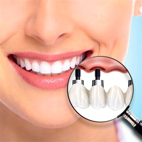 Одномоментная имплантация - Smile Boutique