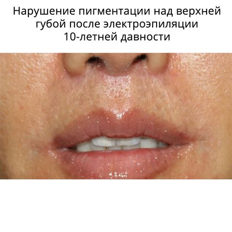 Электроэпиляция