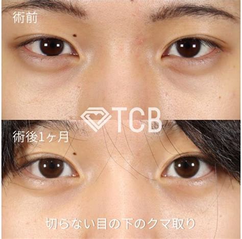 目の下のクマ取りの費用はいくら？美容外科での切らない整形や注射によるクマ取りの値段相場や施術方法を解説 | メディカルアルファ美容医療ガイド
