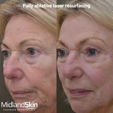 fraxel laser    fully ablative  laser resurfacing