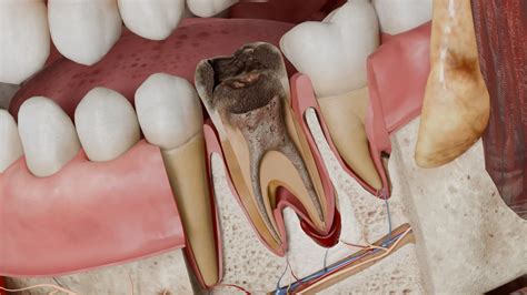 reversible pulpitis etiology diagnosis symptoms treatment