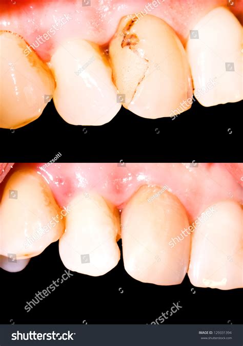 Tooth Restoration Before After Treatment Stock Photo 129331394 | Shutterstock