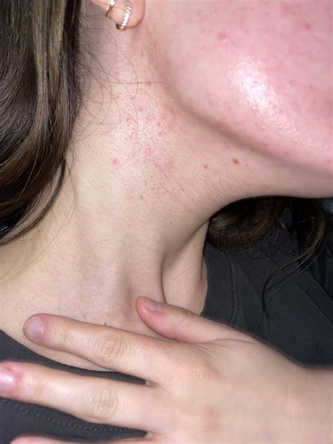 [Routine Help] Is my skin dehydrated? I’m at a loss. : r/SkincareAddiction