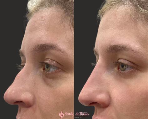surgical rhinoplasty    results