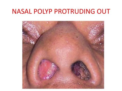nasal polyps pptx ear nose  throat conditions diseases