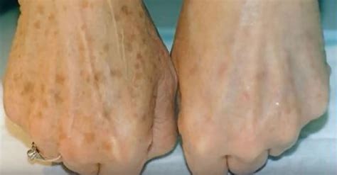 how to get rid of age spots at home