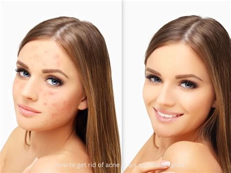 rid  acne scars  black spots