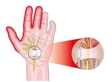 Carpal Tunnel Syndrome | The Pain Relief Clinic